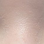 [방탈죄송] 눈 성형수술 망한 케이스 꼭 읽어주세요