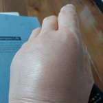 [하소연] 병원 입원 중 혈전성 정맥염 진단 후 <b>진료</b> 거부 보상거부