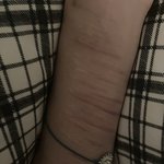 자해 <b>흉터</b> 너무 심해서 고민이다
