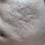 (혐)여드름흉터 <b>새살</b>침