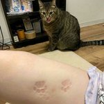 당뇨 정판녀 손가락 상태