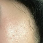 중3피부 사진보고 기초츠천좀