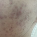 [도와줘] 제발 내 피부 좀 도와줘 ⸝⸝ʚ̴̶̷̆ ̯ʚ̴̶̷̆⸝⸝