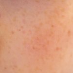 [댓글부탁해] 나 모공에 바퀴<b>벌레</b>가 알 깠다는 쓰닌데