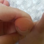 [댓글부탁해] 나 이거 <b>내성</b>발톱이지??? (사진ㅇ)
