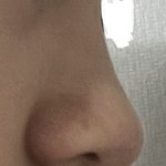 [꼭조언부탁] 콧볼이 너무 넓어서 고민이에요