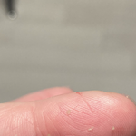 혐주의) 이런 피지 <b>압출</b>밖에 답 없냥