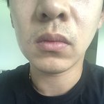 [꼭조언부탁] 신경치료후 마비증상