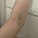 [댓글부탁해] <b>피검사</b>했는데 팔에 멍듦..