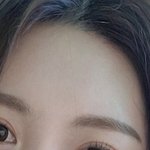이마지방이식 할까요???? 사진있어요