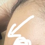 나 이마 <b>필러</b> 맞을까?