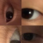 (재업) 쌍수 성공할수 있을까 중1임