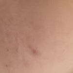 <b>사진</b> <b>O</b>) 이런 여드름 흉터는 어케없애?