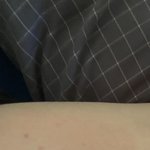 [댓글부탁해] 혐주의) 모기 ㄹㅈㄷ많이 <b>물림</b>