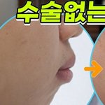 [댓글부탁해] 진짜 <b>무턱</b>은 이런거임