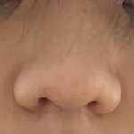 나 <b>겨</b>방에 콧볼축소 할까