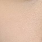 [꼭조언부탁] 여드름 피부과 가본사람…(혐)