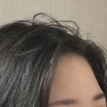 이마 꺼진 거 어캄
