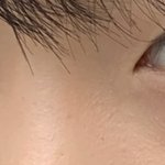 눈 밑 지방<b>재배치</b> 할까 말까