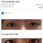[드루와] 남자 쌍꺼풀 제거<b>수술</b> 성공 케이스 ㅋㅋㅋ