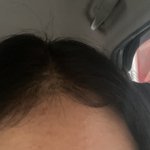 [댓글부탁해] <b>이</b> 잔머리는 헤어라인 왁싱으로도 <b>안</b> 됨 ㅠㅠ?