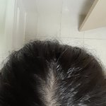 [댓글부탁] 학생인데ㅠㅠ <b>탈모</b>야?ㅠ