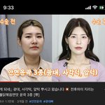 <b>안면</b>윤곽 ㅈㄴ 뿜뿌온다