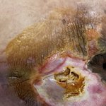 요양병원 <b>욕창</b>(혐오사진 주의)