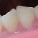 이 정도면 <b>덧니</b> 심한 거냐