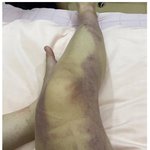 이태원현장 생존자 다리 멍 사진 ㄷㄷ