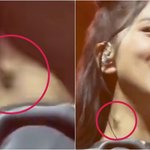 지수 목에 <b>종양</b> 아님?