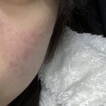 [댓글부탁해] 피부 이렇게 붉은거 뭐임? <b>색소</b>침착?