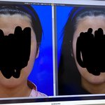 [댓글부탁해] ++) 진심으로 안면윤곽 하고싶은데..(사진있음