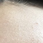 여드름패치 아주 <b>열일</b>하고있구만