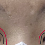 [꼭조언부탁] 성형 쌍수 <b>재수술</b> 조언 부탁드립니다 (윗트임 고민(