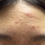 [조언부탁해] <b>좁쌀</b>여드름 없애는 방법좀 ㅠㅠ