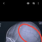 수술진행, 단신뉴스 나감, 수술 전후아기사진 및 <b>CT</b> 추가첨부)