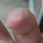 손가락 <b>화상</b> 치료 어떻게 해?