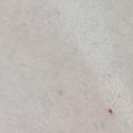 <b>여드름패치</b> 붙여 말어