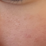 <b>나비존</b> 모공 줄이는 법 없냐 나 진짜 ㄹㅈㄷ야