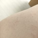 [알려줘] <b>모공</b>각화증  어떻게 관리해야함?