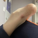 이 딱지는 언제쯤 <b>사라</b>질까?