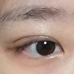 쌍수 2주 좀 넘었는데 붓기 넘 빨리빠짐