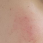 [이것좀봐줘] 제발 한번만 봐주세요..여드름 크림좀ㅜㅜ