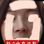 강남역 대형병원 대표원장님께 들린코 2번 수술 받은 결과 어때요...