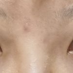 <b>돌출</b>눈 수술 할까 말까???