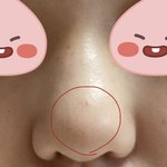 (사진주의)<b>복코</b> 시술 ㅊㅊ좀..