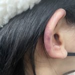 [댓글부탁해] 유명 성형외과에서 수면마취 깨울때 피멍..