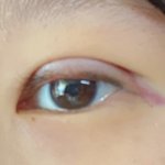 [꼭조언부탁] 나 방금 <b>쌍수</b> 하고 왔는데 잘된거 같앙? ㅠㅠ (눈...