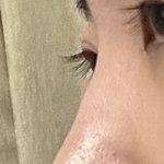 이런 코는 수술이나 시술 뭐해야됨??(피부 주의)